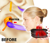 Neck Traction, Air Neck Traction, How Air Neck Traction Works,